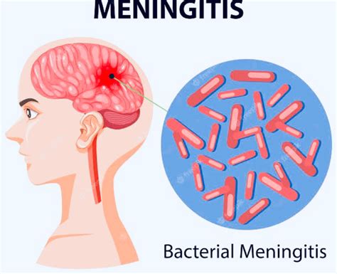 what what is meningitis